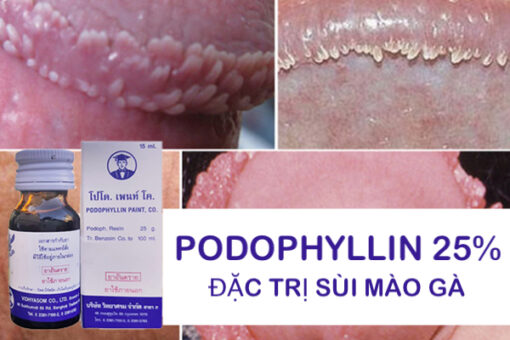 Thuốc Podophyllin 25 Thái Lan chữa trị sùi mào gà tại nhà cho nam nữ - Ảnh 2